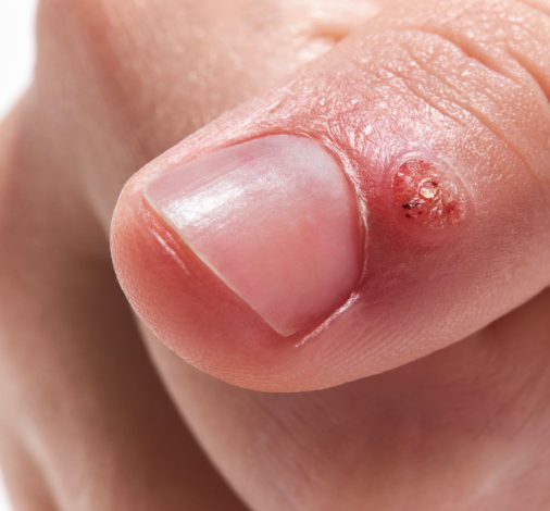 Traitement des verrues